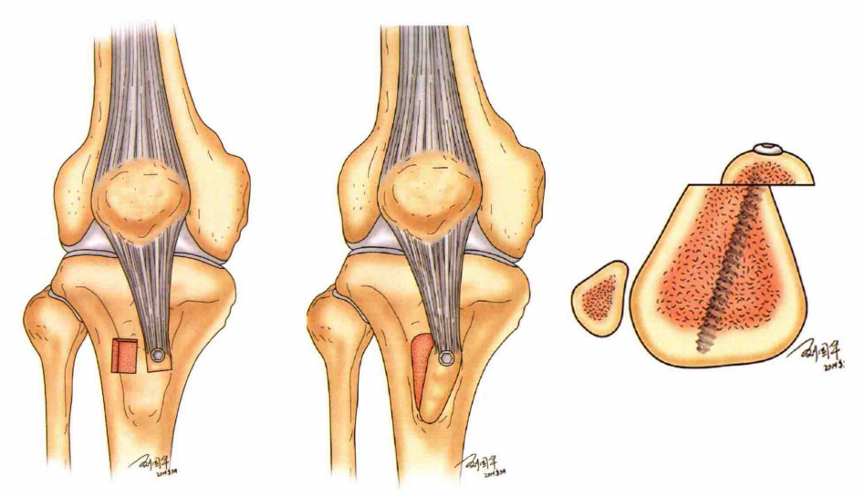 内侧髌股韧带重建 外侧支持带松解 胫骨结节移位术:这是所谓的髌骨
