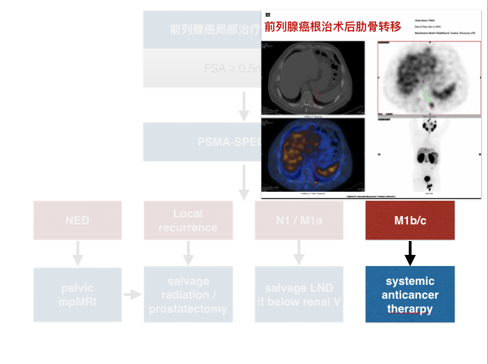 PSMA检查精确诊断前列腺癌的应用实例(可门