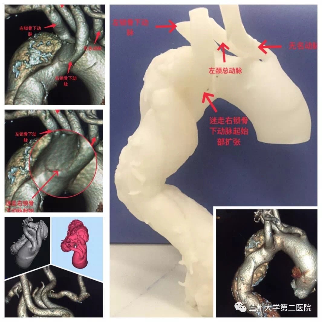 兰3d打印辅助体外开窗技术全腔内治疗罕见胸主动脉夹层