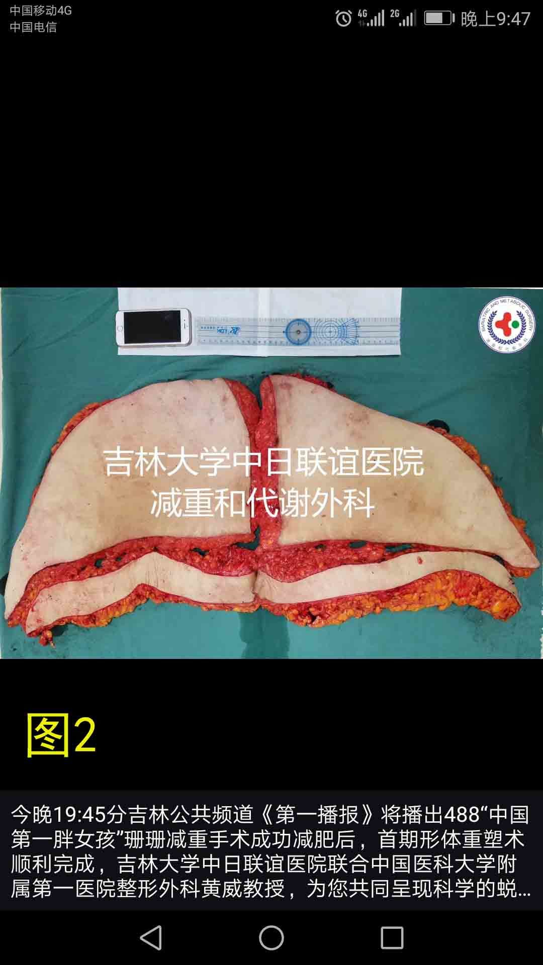 为中国第一胖的女孩做腹壁整形