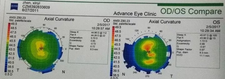 小孩子也要戴隐形眼镜?RGP和OK镜和一般的