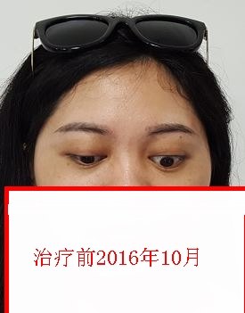 重症甲亢突眼怎么治疗?突眼典型病例治疗前后照片对照(图)