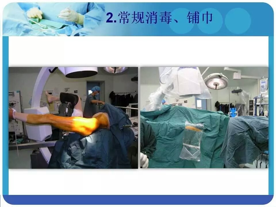 pfna治疗股骨粗隆间骨折,让你看明白