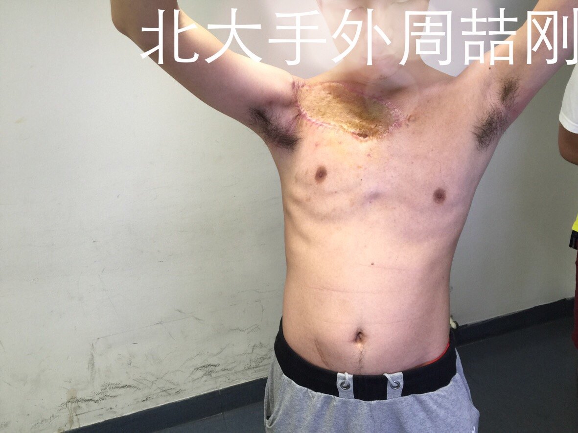 胸壁巨大隆突性皮肤纤维肉瘤的根治性切除