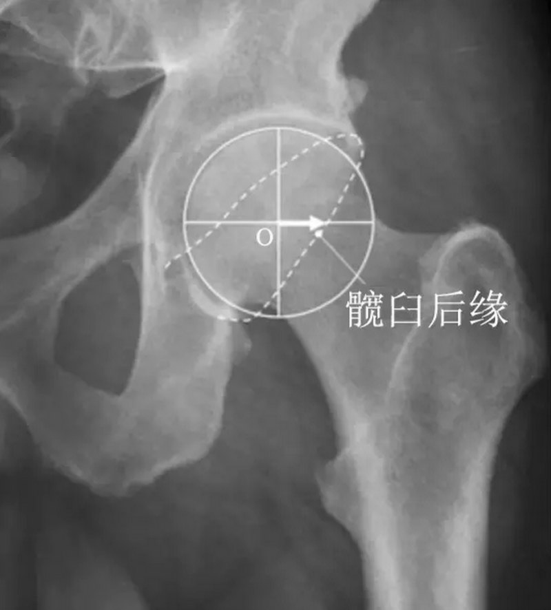 【股骨髋臼撞击症】骨科医生应该了解的髋股撞