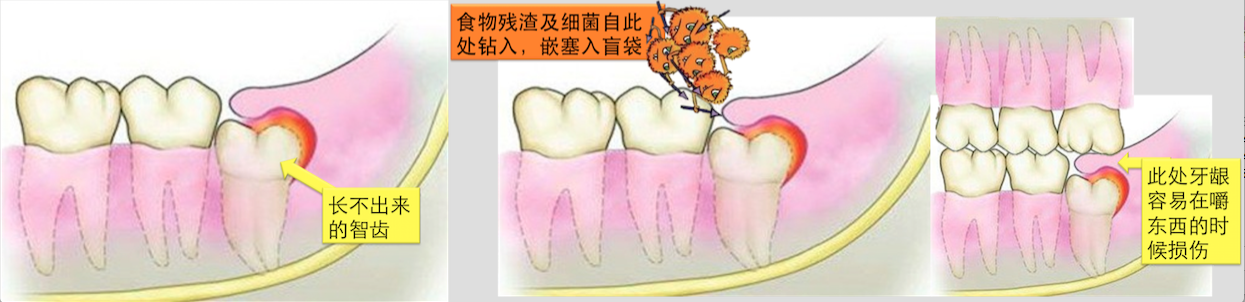 牙龈会部分或全部覆盖在智齿表面,并在牙龈与牙之间形成较深的盲袋