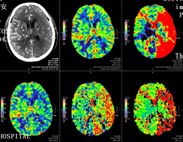上图是一例右侧颈动脉重度狭窄患者的ctp检查结果,右侧大脑半球供血