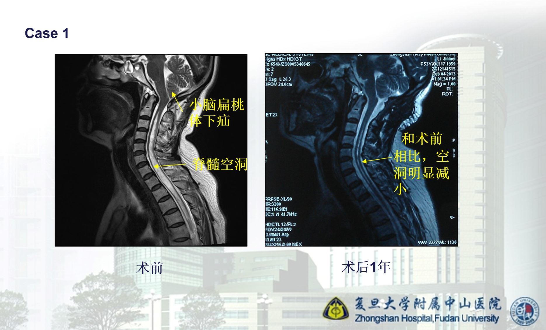 颅颈交界畸形系列二小脑扁桃体下疝脊髓空洞