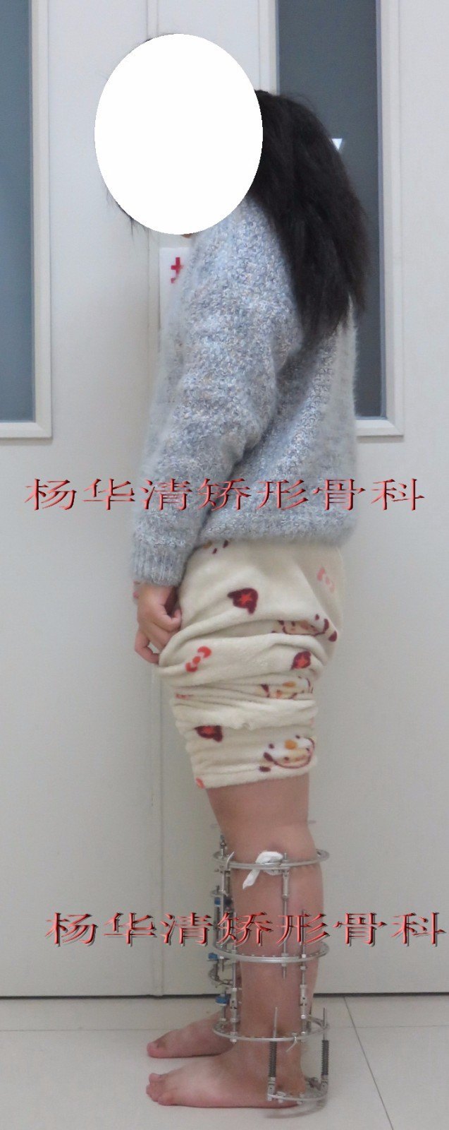o型腿o形腿重度膝内翻病例