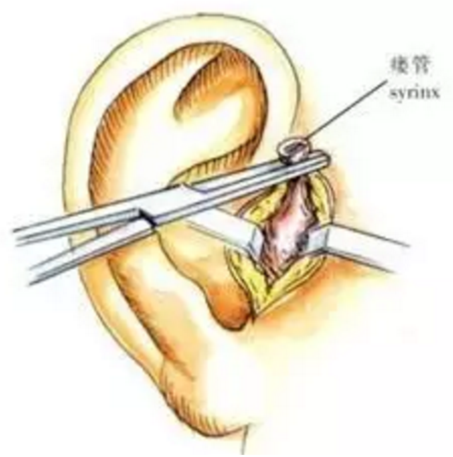 耳前瘘管 宝宝耳朵旁有个洞的,宝妈一定要进