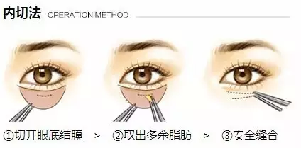 手术去眼袋,内切外切怎么选?