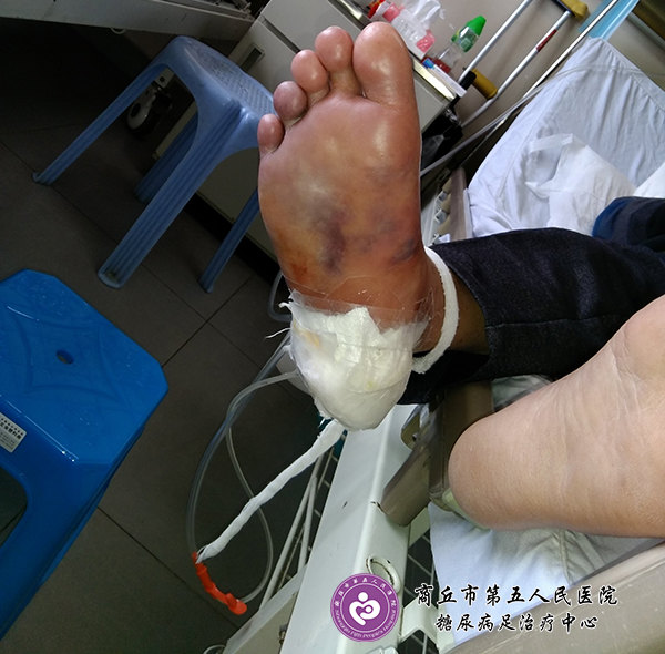 治疗方法不当导致严重面临要截肢地步的案例