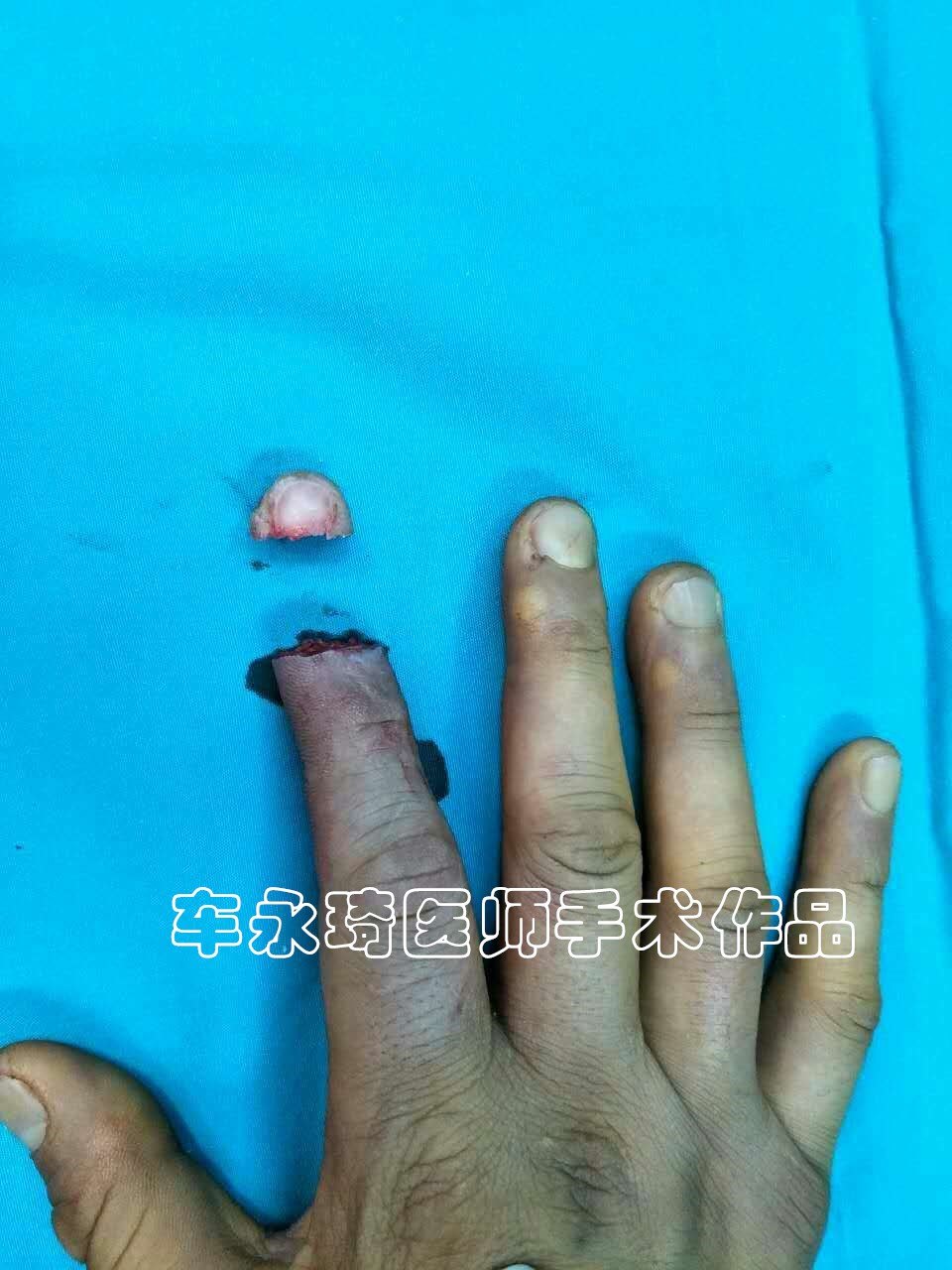 手指断了怎么办?