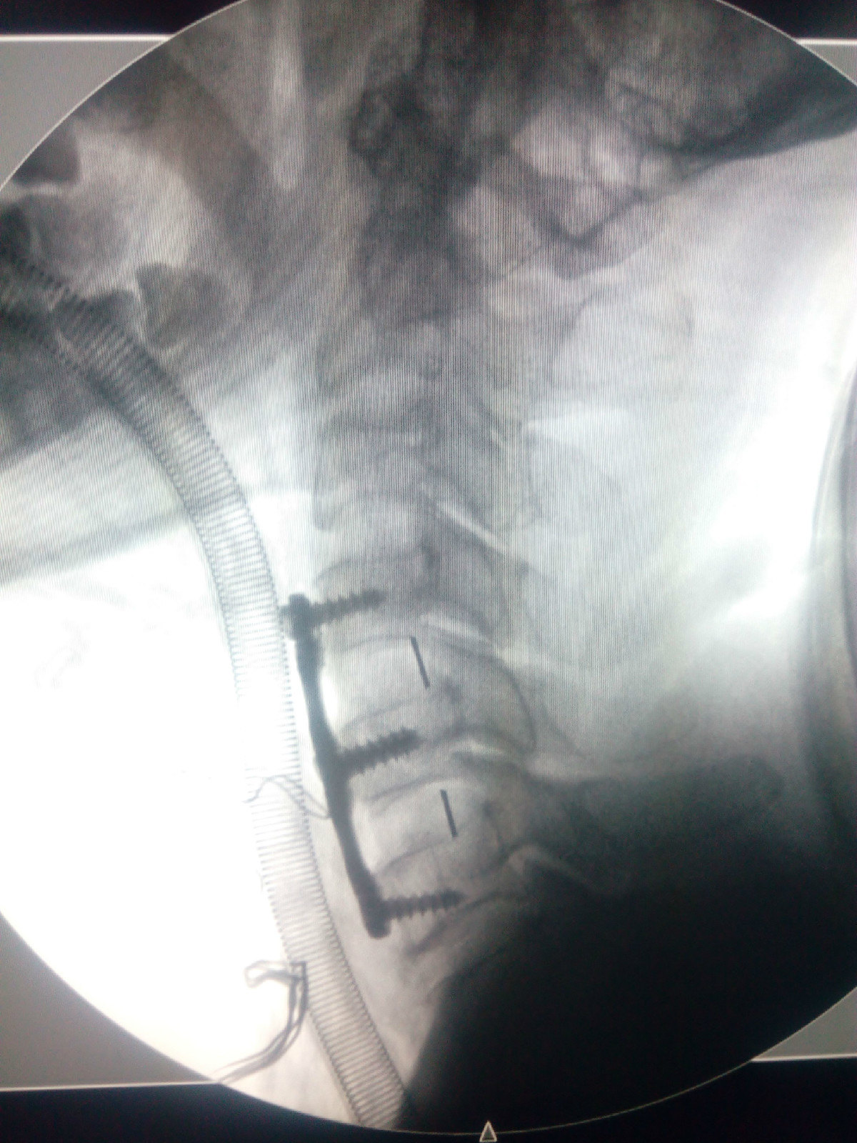 病例3-脊髓型颈椎病-颈椎前路减压固定融合术
