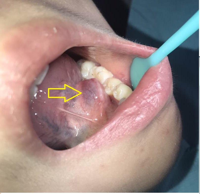 舌下腺囊肿,先试一试简易保守治疗