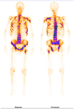 肿瘤骨转移与放射性核素骨扫描