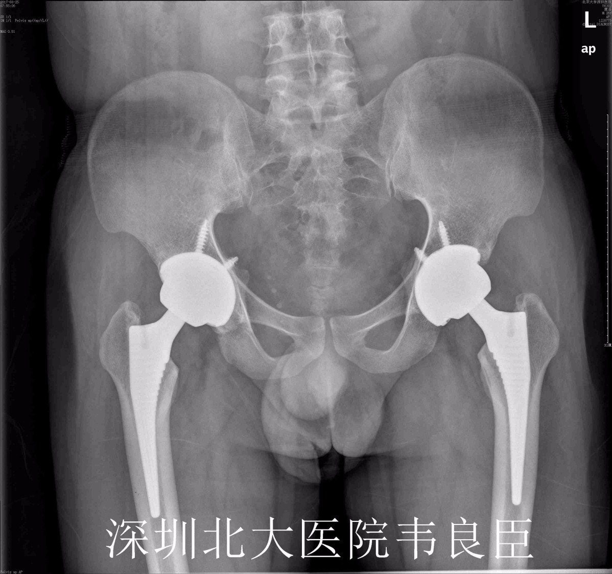 股骨头坏死行人工髋关节置换术x片示例