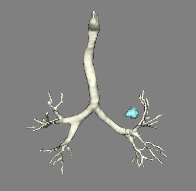 三维重建技术,助力精准微创手术--肺结节患者的
