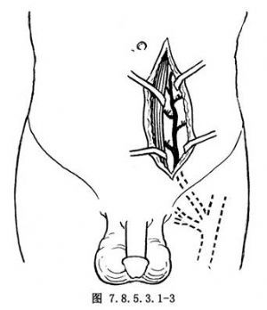 静脉漏阳痿手术治疗的新方法:腹壁下动脉与阴