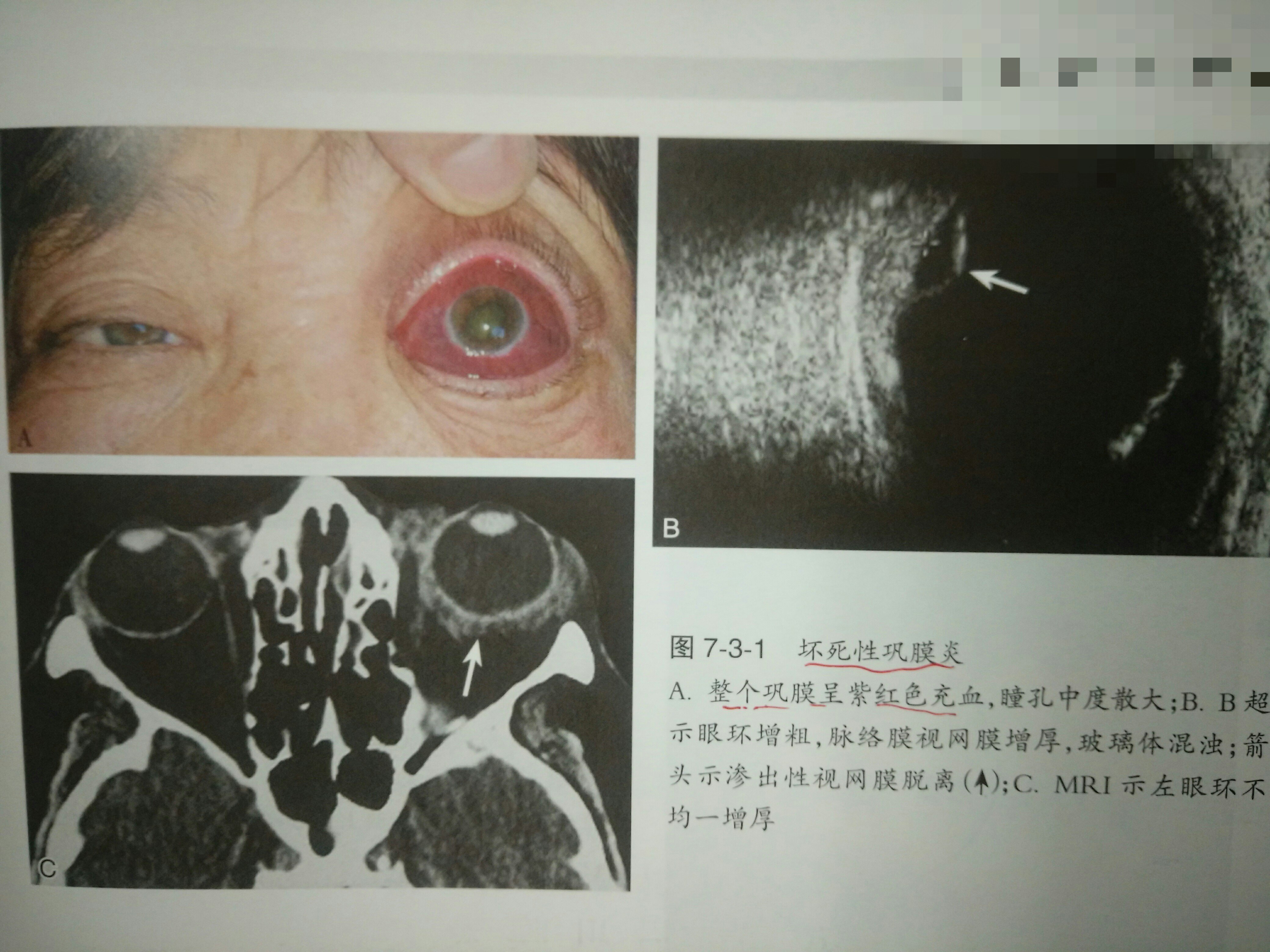 性巩膜炎发病时眼痛剧烈,进展迅速,视力显著下降甚至无光感,眼球突出