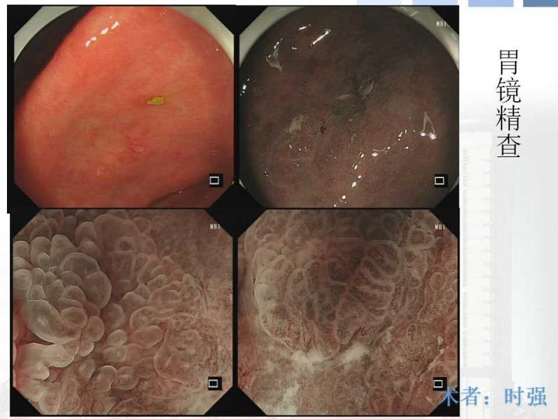 早期胃癌的精查和内镜治疗(二)