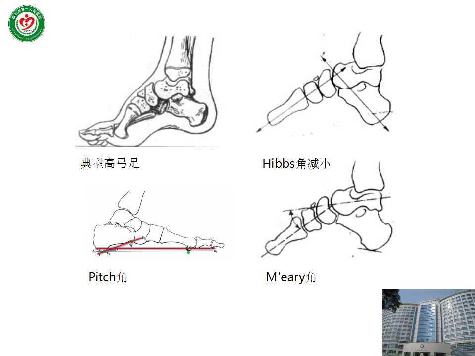 高弓足诊疗