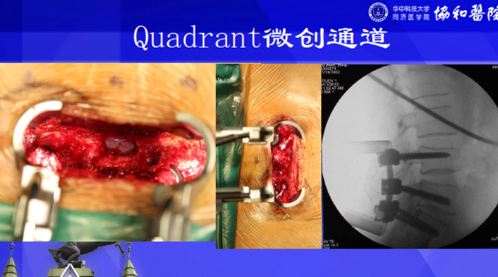 腰椎间盘突出症的微创手术治疗