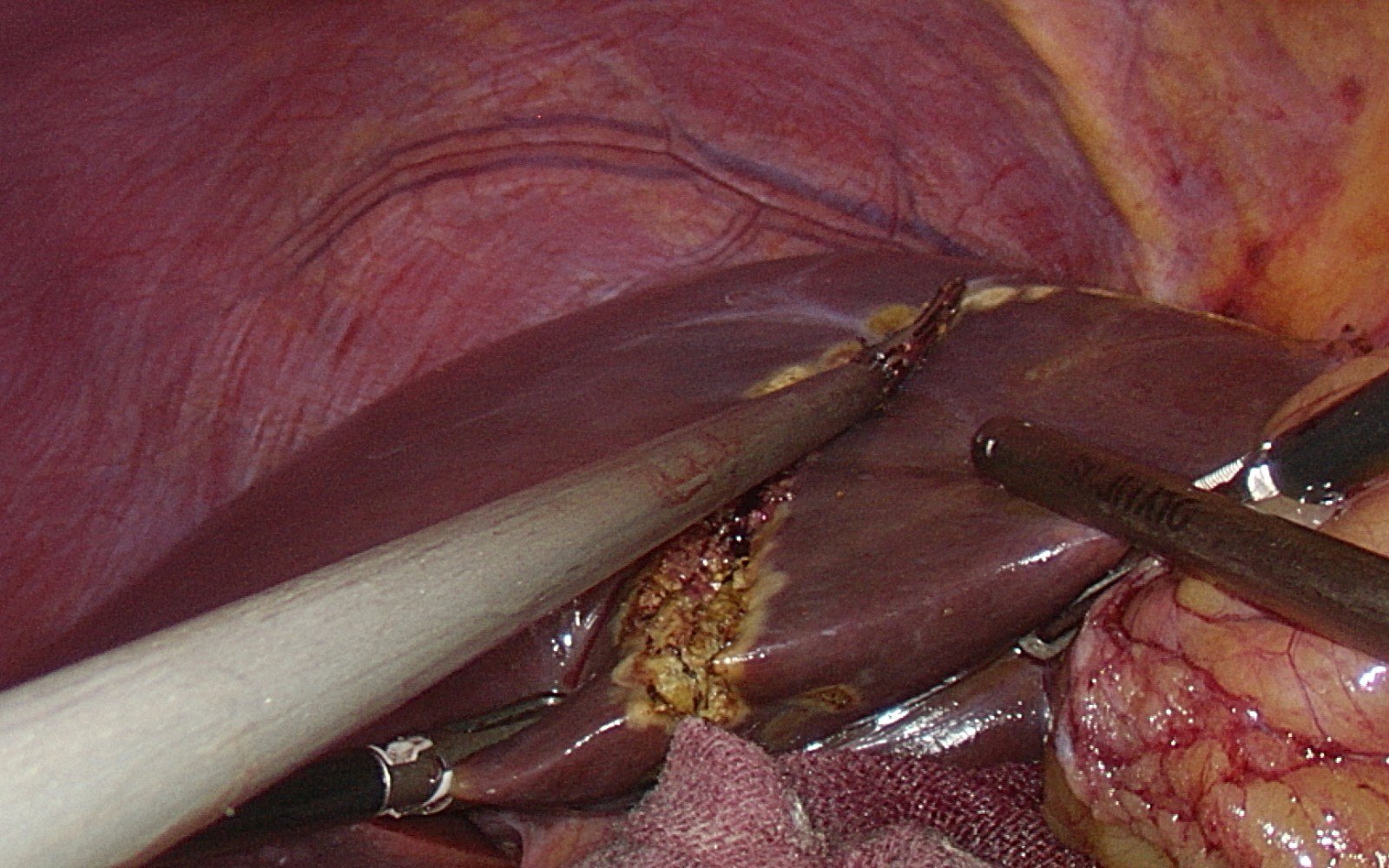 千枚胆囊结石的腹腔镜胆囊切除术1例