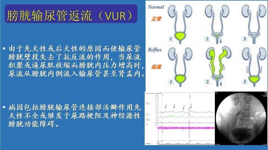 膀胱输尿管返流介绍及治疗方法