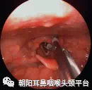 电子喉镜直视下应用喉异物钳行环杓关节复位术