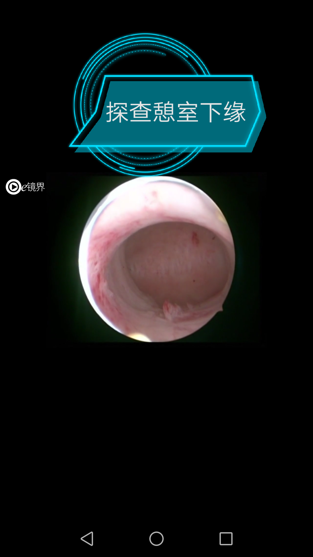 手术解析:宫腔镜下切除-剖宫产术后子宫切口憩