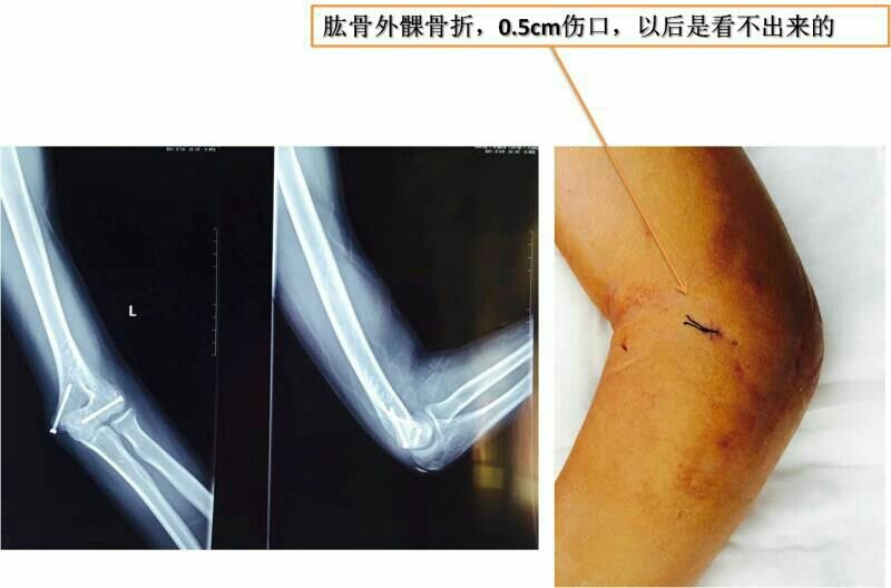 弹性髓内钉治疗股骨骨折!