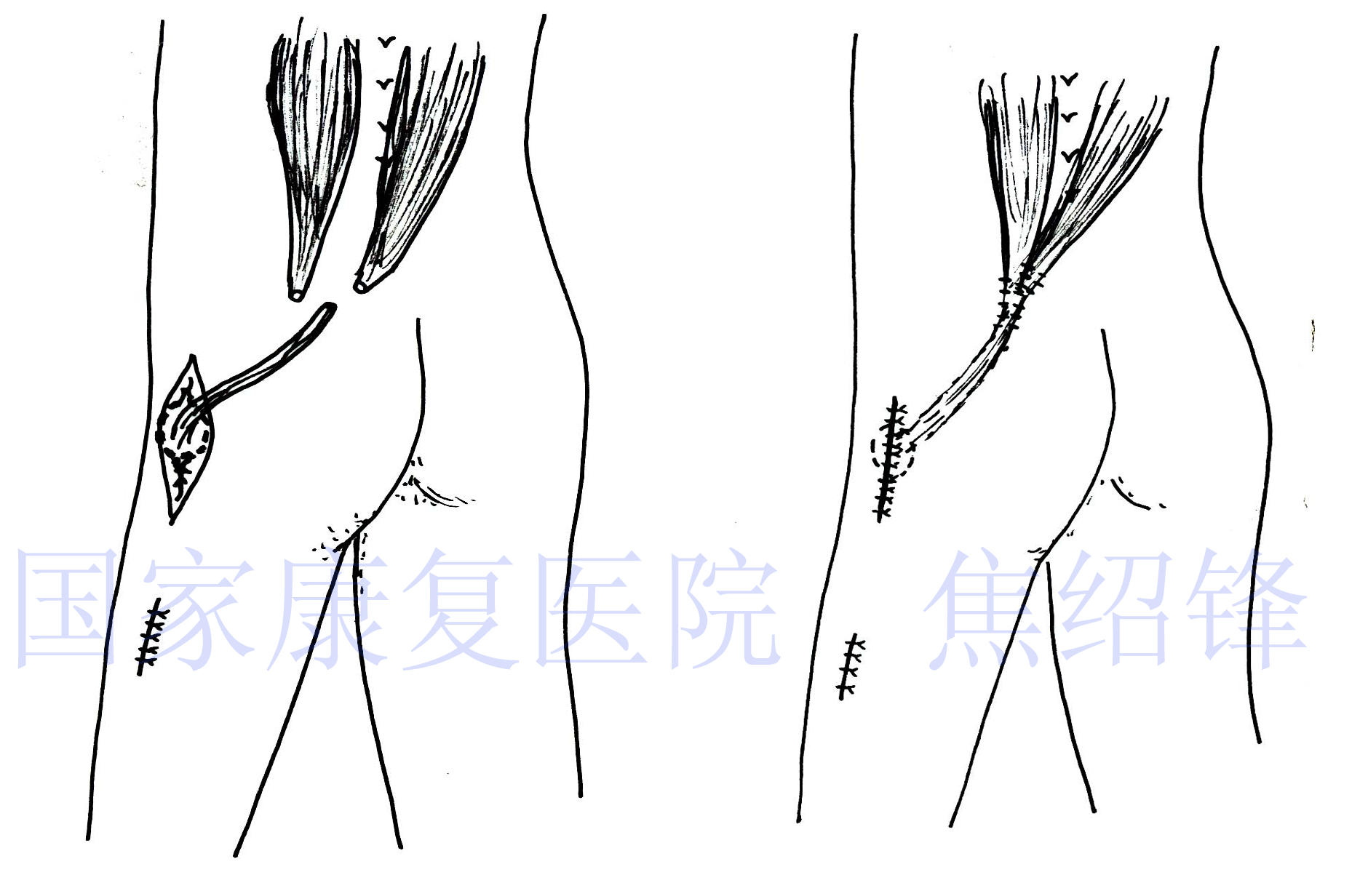 骶脊肌代臀肌.png