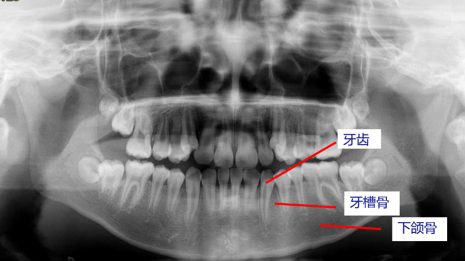 牙齿不光有我们口内能看到的部分,还有长长的牙根埋在牙槽骨里,就像