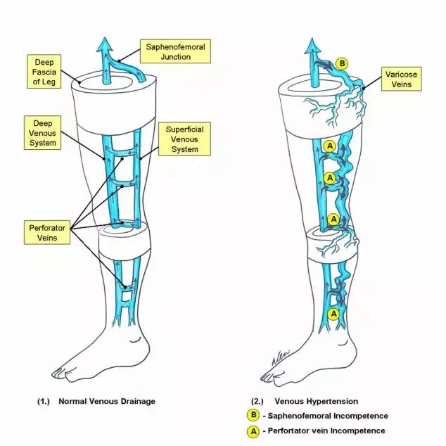 下肢静脉曲张诊断与治疗