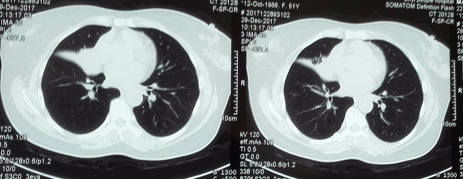 肺不张肺癌管腔堵塞支气管镜检查告诉你答案