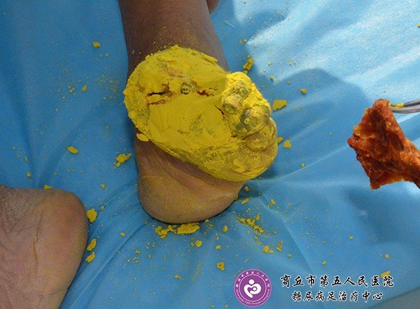 中医膏药治糖尿病并发症烂脚效果怎么样?