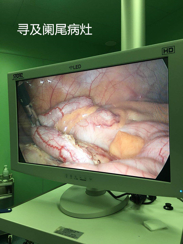 阑尾炎是否需要手术?微创阑尾切除术的优势_