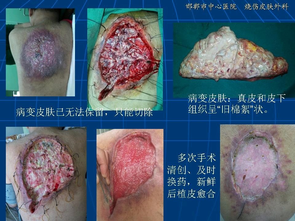 诊断:皮肤软组织感染,贫血,低蛋白血症,电解质紊乱,糖尿病,糖尿病肾病