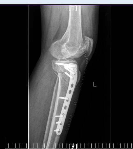 胫骨平台骨折术后骨性愈合