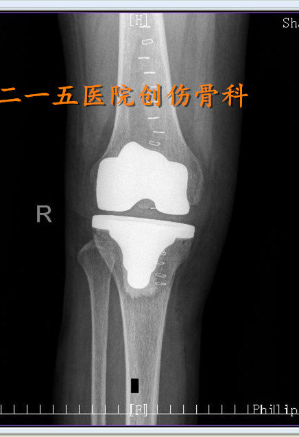 膝关节退行性骨性关节炎