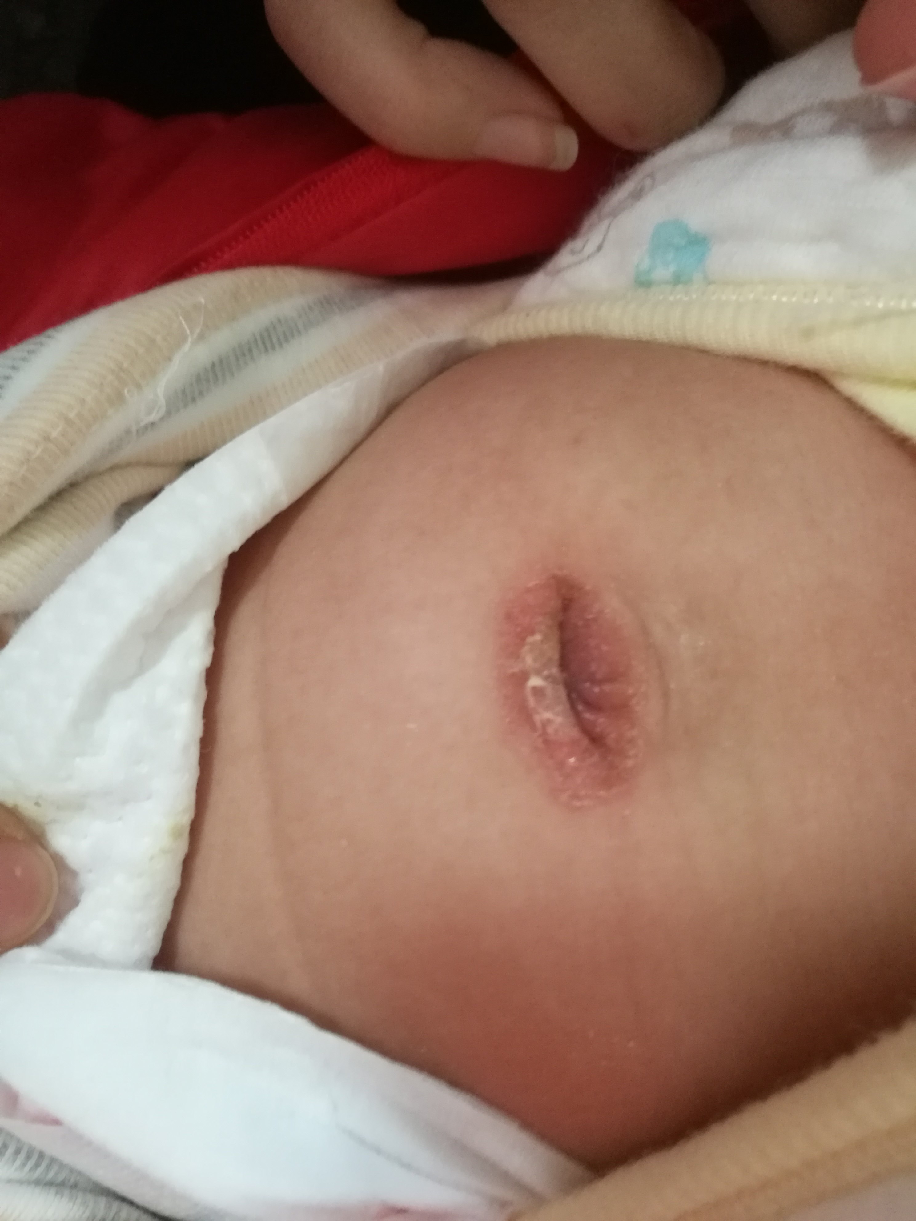 肚脐处的湿疹,有的宝宝肚脐经常渗液