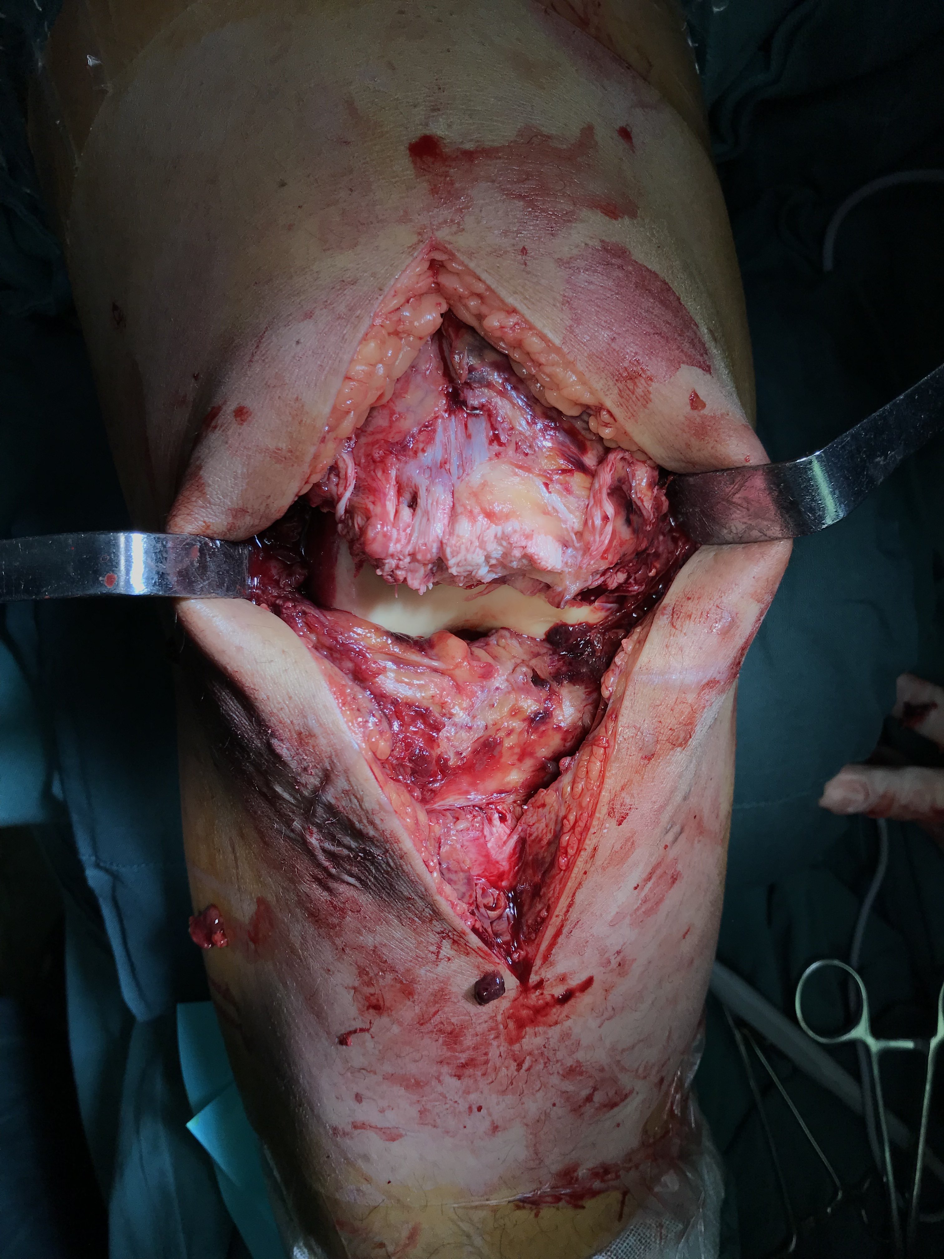 膝关节髌韧带陈旧损伤,断裂,人工lars韧带重建术