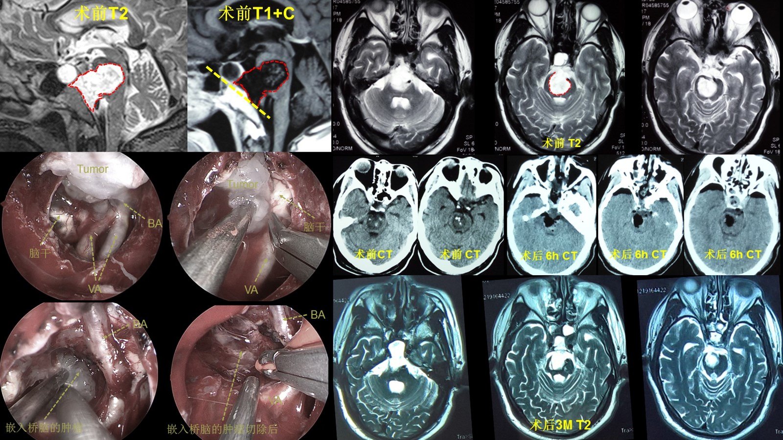 颅底肿瘤脊索瘤等的扩大经鼻颅底内镜微创手术治疗