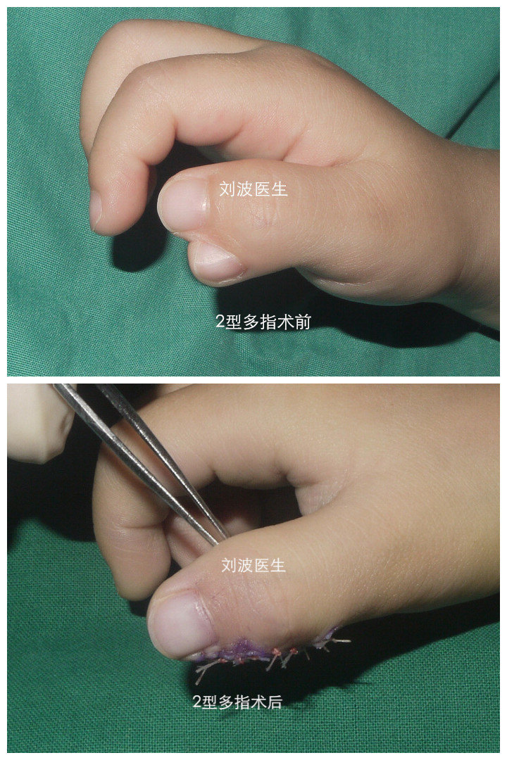 刘波医生治疗2型桡侧多指(多拇,重复拇)畸形手术照片