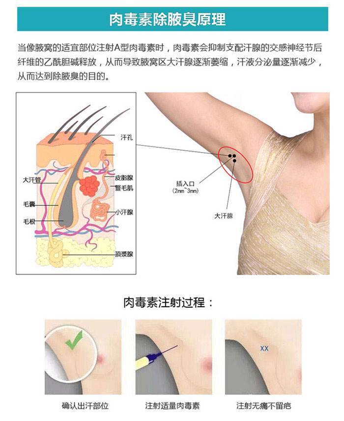 肉毒素治疗腋臭的优缺点