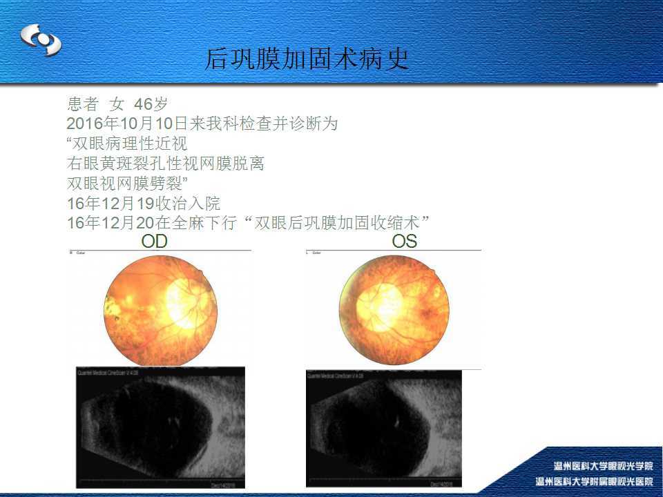 psrc治疗高度近视视网膜劈裂典型病例三psrc治疗高度近视视网膜脱离