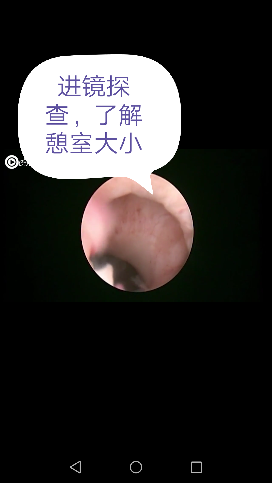 手术解析:宫腔镜下切除-剖宫产术后子宫切口憩