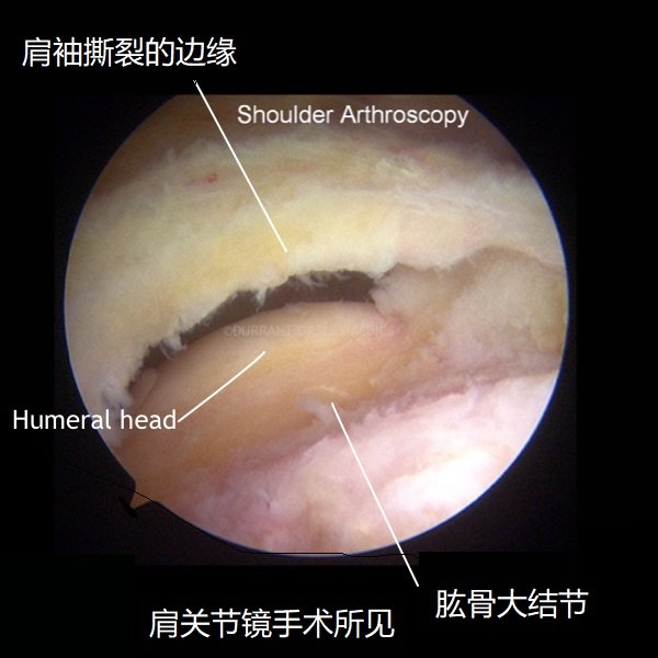 rotator-cuff-tear-arthroscopy.jpg