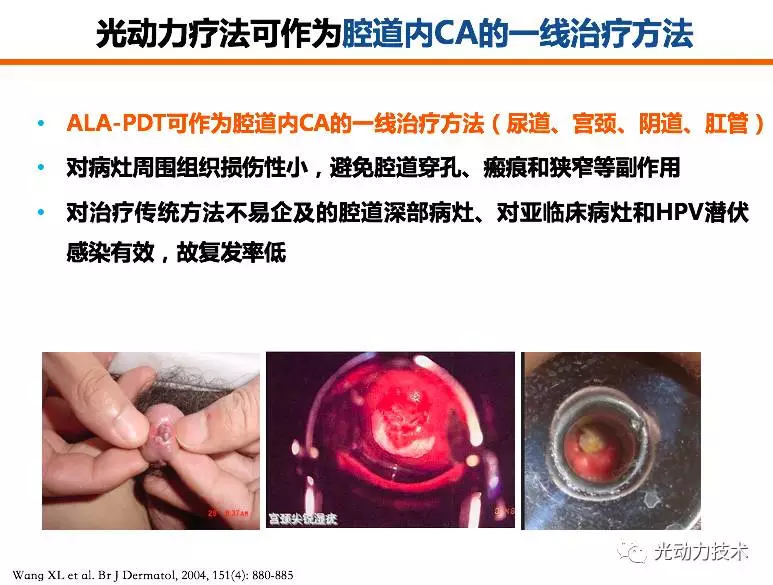 ALA-PDT(光动力治疗)在女性尖锐湿疣的应用